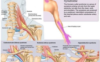 Thoracic Outlet Syndrome